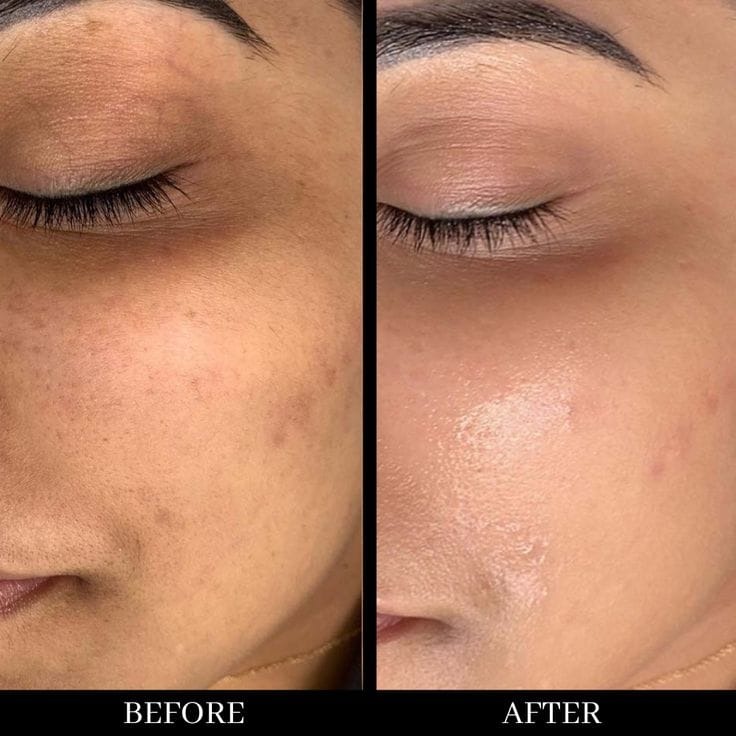 Clinical laser skin rejuvenation treatment process